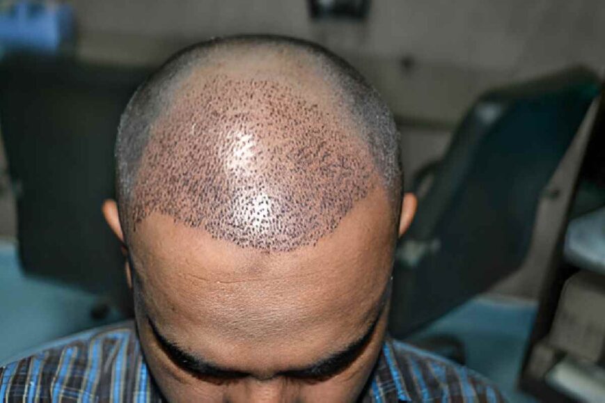 Cost of Hair Transplant in India