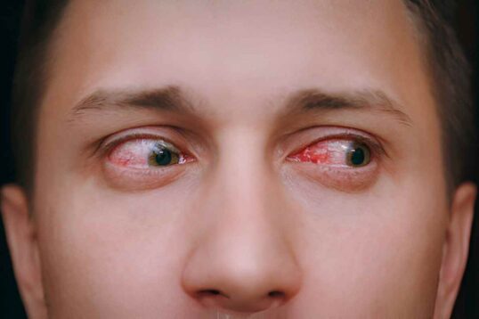 What is Commonly Misdiagnosed as Pink Eye_