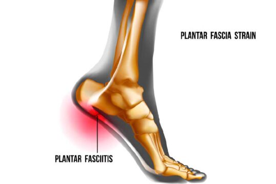 Plantar Fasciitis Surgery