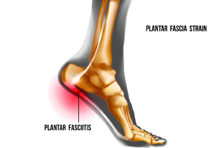 Plantar Fasciitis Surgery