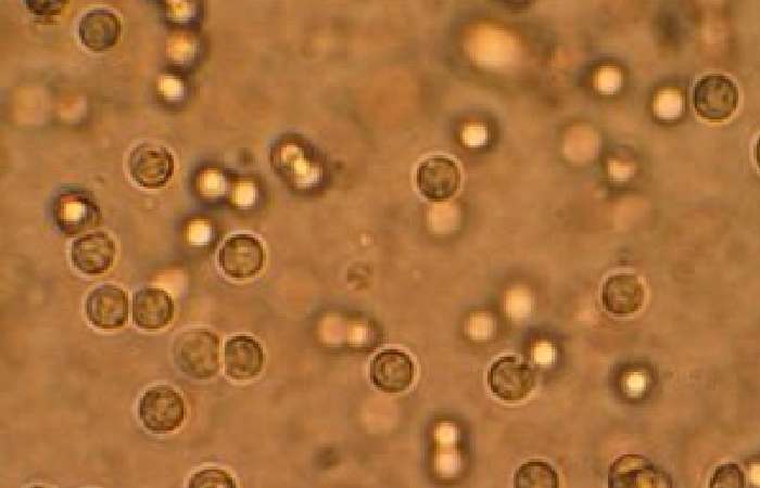 Pus Cells in Urine 25-30 Hpf Treatment (1)