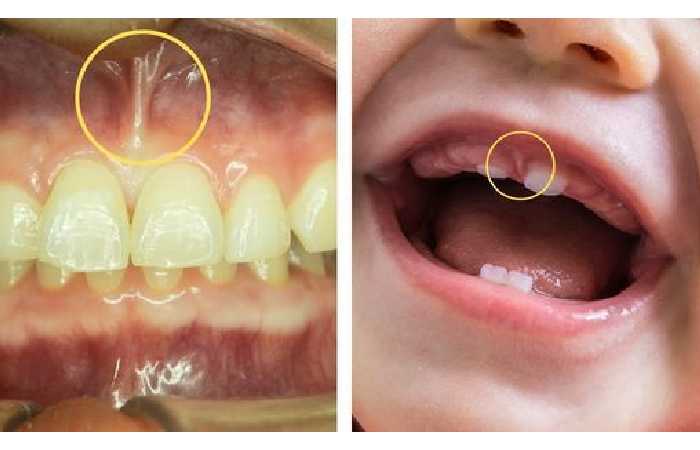 Tongue Tie Vs. Normal Adults (1)